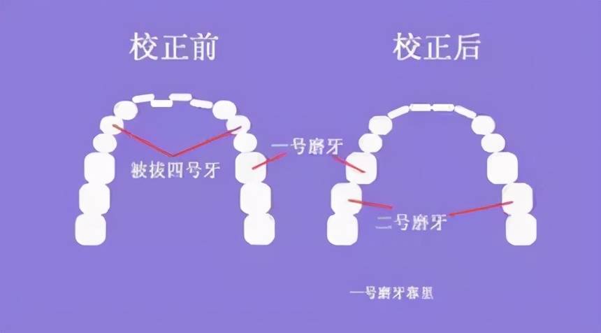 上牙槽骨突出怎么改善 牙槽骨突出怎么矫正