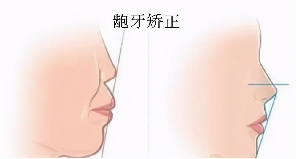 上牙槽骨突出怎么改善 牙槽骨突出怎么矫正