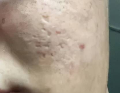 毛孔粗大几年了还能恢复吗 毛孔粗大怎么办