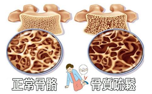 中年人如何增强自己的骨密度？