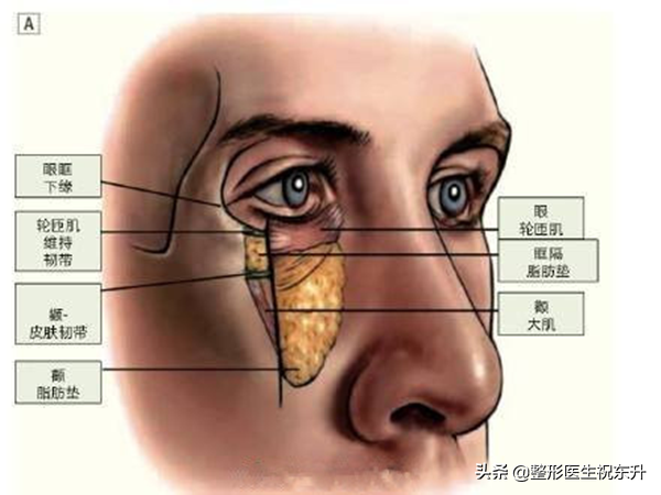 去眼袋最有效的小窍门 怎么治疗眼袋