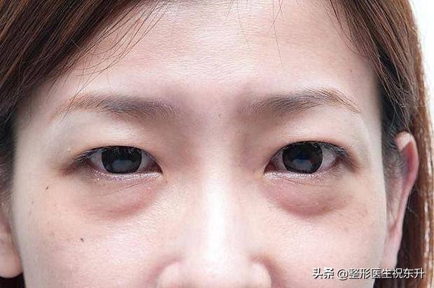 去眼袋最有效的小窍门 怎么治疗眼袋