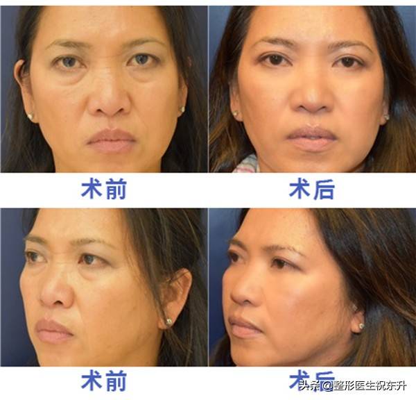 去眼袋最有效的小窍门 怎么治疗眼袋
