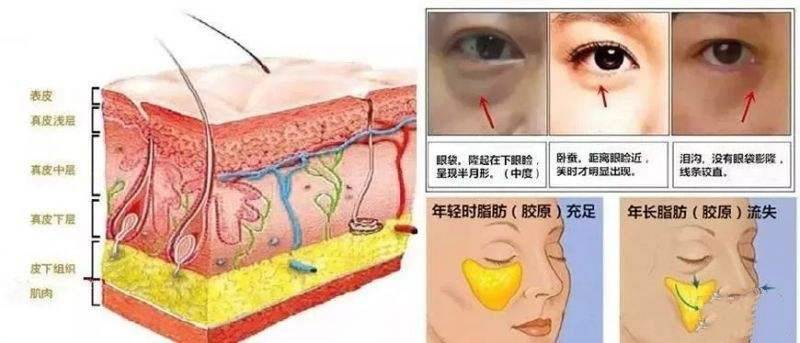 十分钟快速去眼袋 怎么去下眼袋