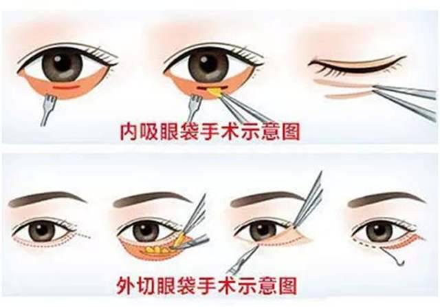 十分钟快速去眼袋 怎么去下眼袋