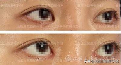 开眼角的图片前后对比 怎么开眼角