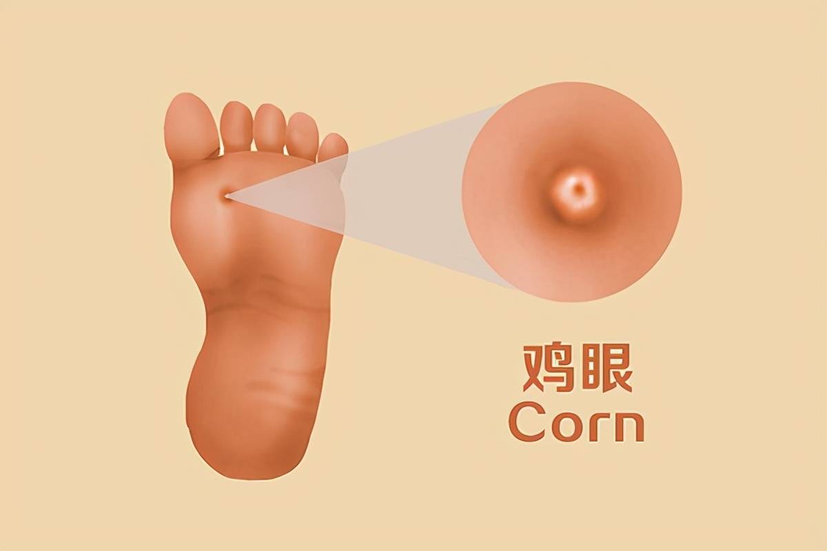 鸡眼的根有多深 鸡眼怎么治疗