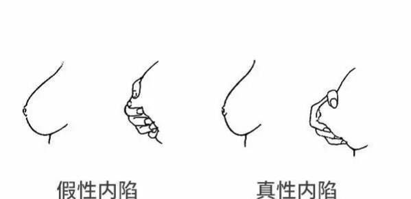 怎么解决乳头内陷的问题 乳头内陷怎么办