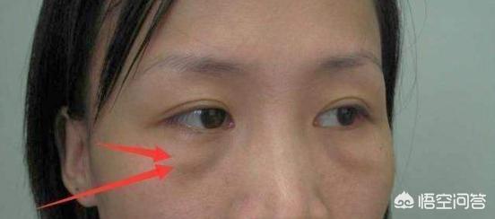 人上了40岁以后眼袋很严重，有什么好的方法可以有效祛眼袋？