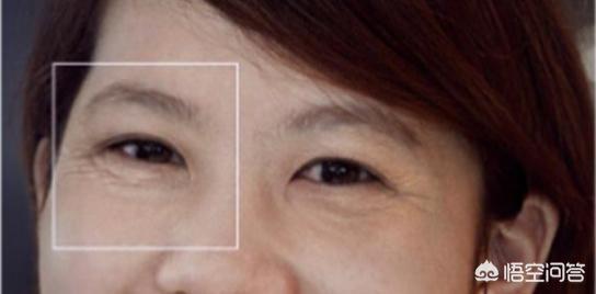 人上了40岁以后眼袋很严重，有什么好的方法可以有效祛眼袋？