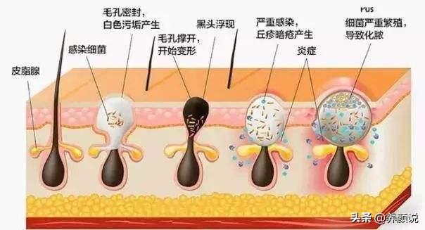 干性皮肤好还是油性皮肤好?