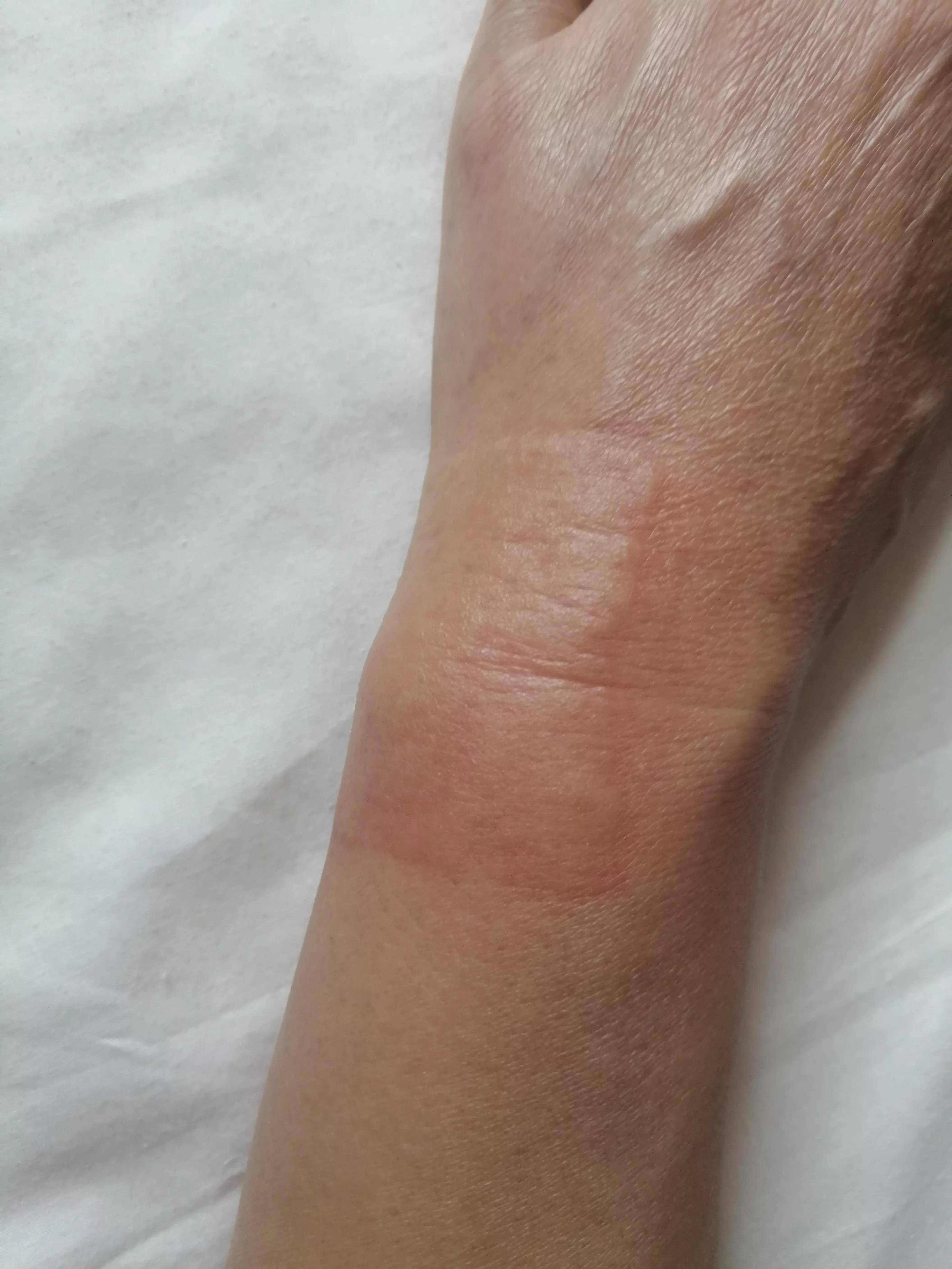 淘宝上买的药膏过敏怎么办 膏药过敏怎么办