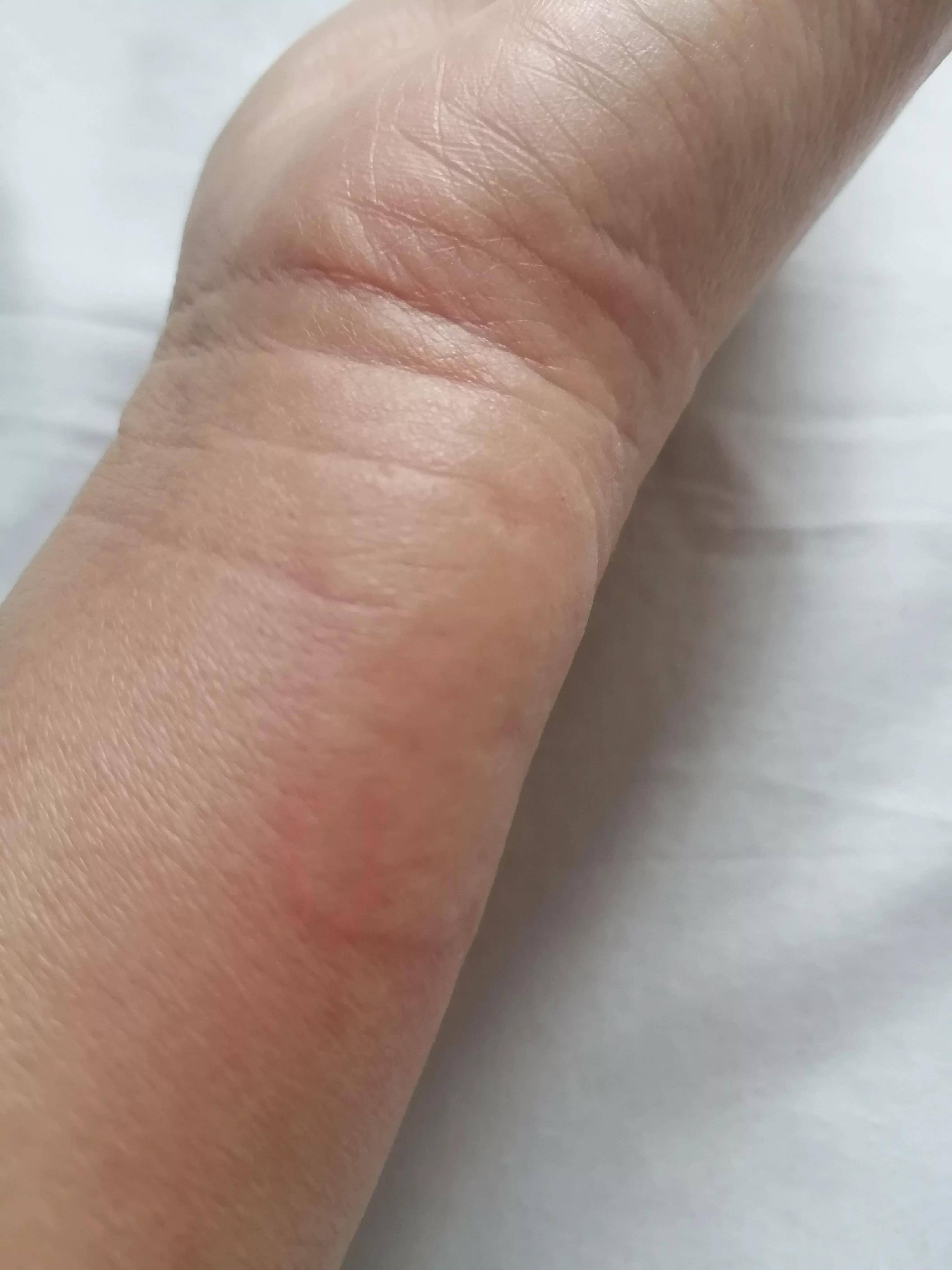 淘宝上买的药膏过敏怎么办 膏药过敏怎么办