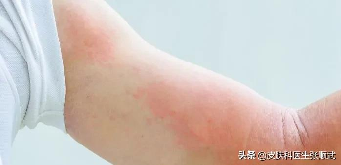 荨麻疹忌口食物一览表 荨麻疹多久才能好