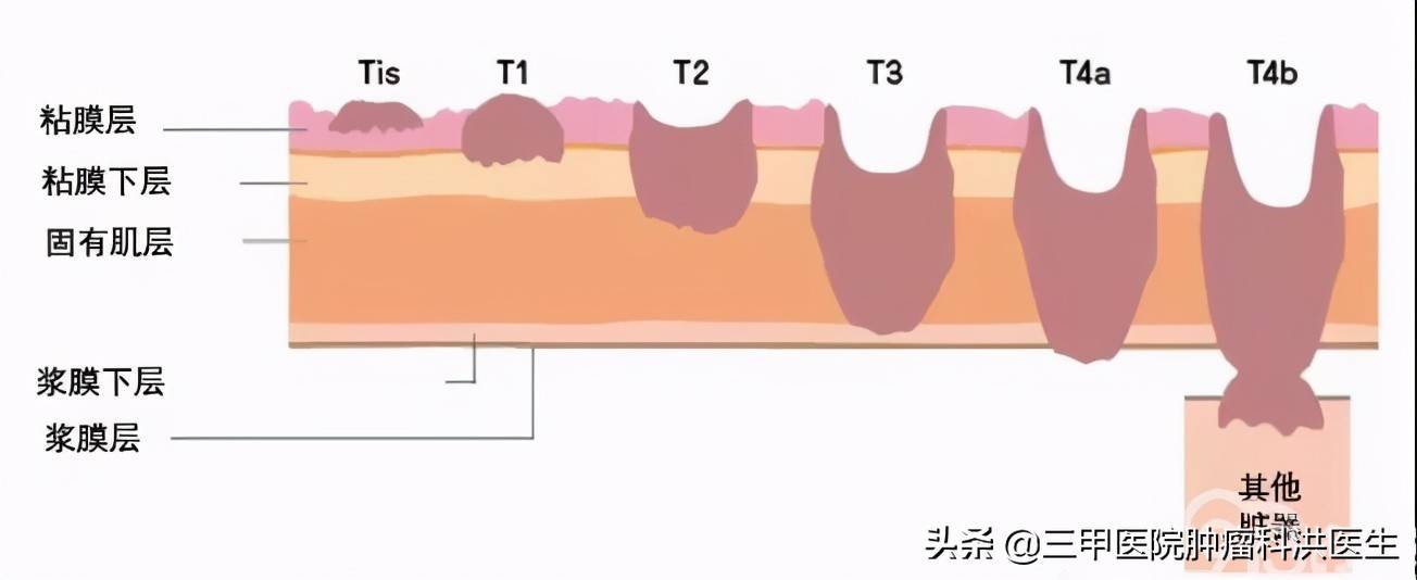 结肠癌死前三二天表现 结肠癌晚期能活多久