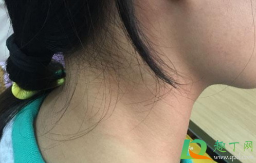 脖子上长小肉粒是什么原因