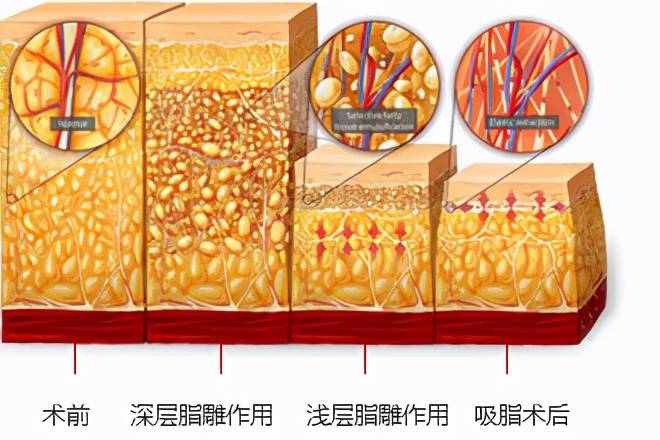 抽脂多久能恢复好啊 腹部抽脂多久恢复