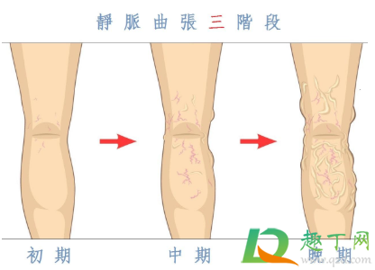静脉曲张需不需要做手术