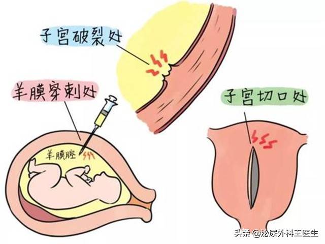 子宫全切手术时间多长 子宫全切多久