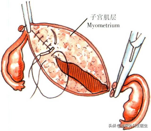 子宫全切手术时间多长 子宫全切多久