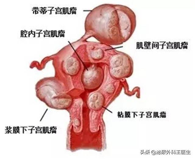 子宫全切手术时间多长 子宫全切多久