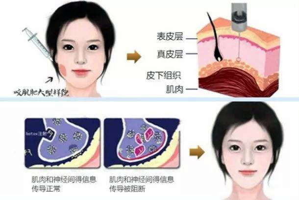 医生自己注射瘦脸针 瘦脸针维持多久