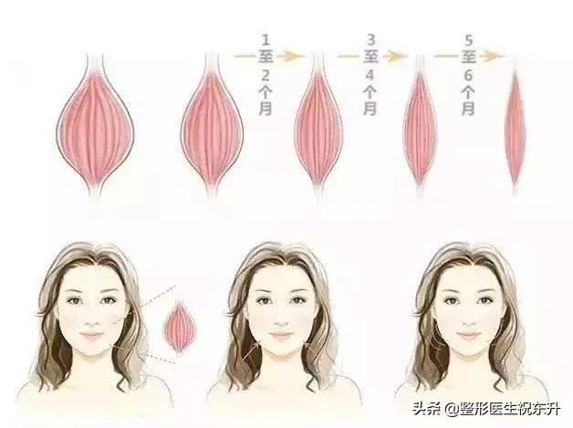 医生自己注射瘦脸针 瘦脸针维持多久