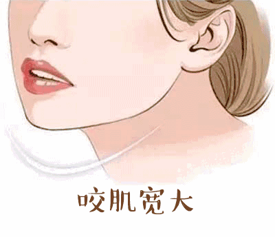 医生自己注射瘦脸针 瘦脸针维持多久
