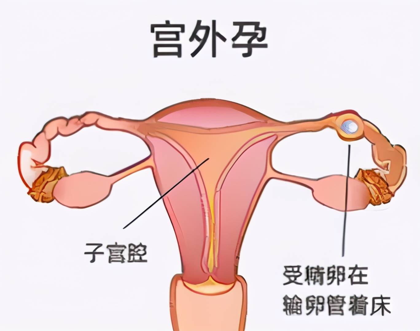 怀孕7天到14天症状 宫外孕多久能发现