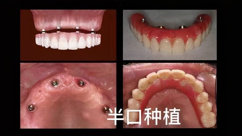 抽牙神经要抽多少次 抽牙神经多久