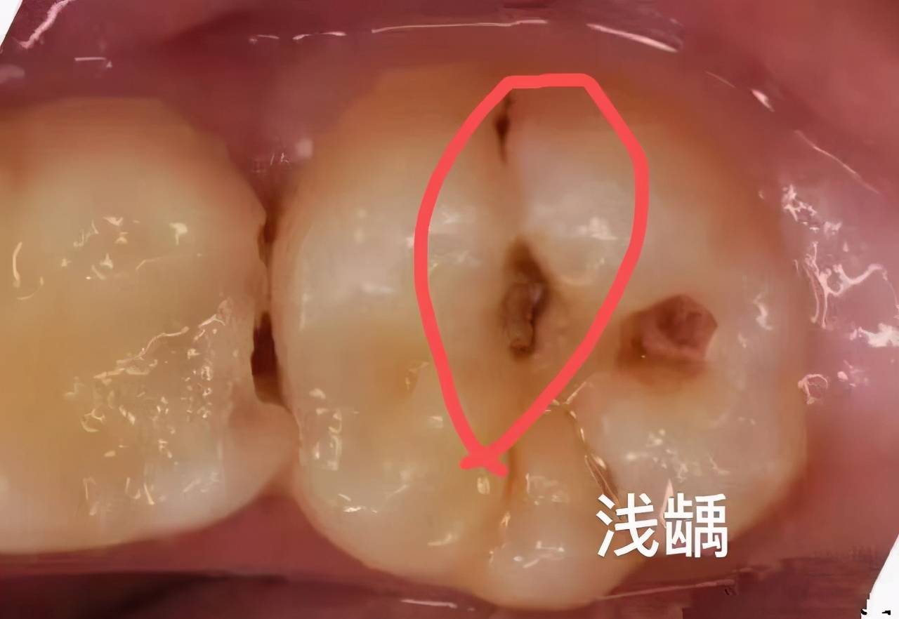 抽牙神经要抽多少次 抽牙神经多久