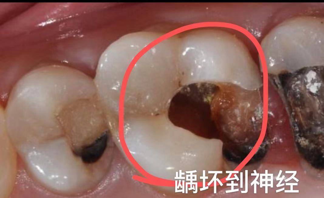 抽牙神经要抽多少次 抽牙神经多久