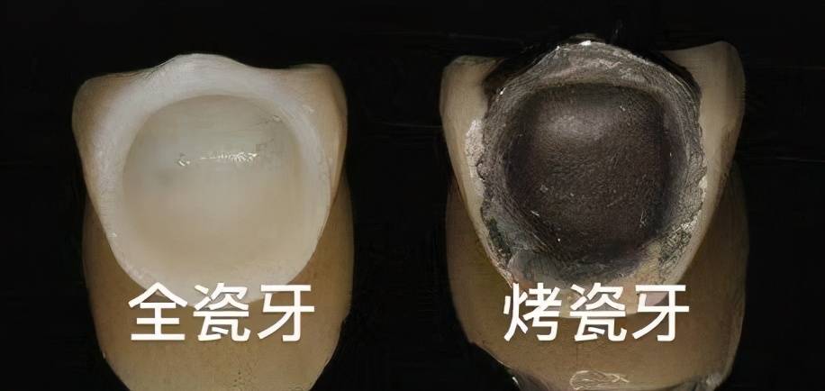 抽牙神经要抽多少次 抽牙神经多久