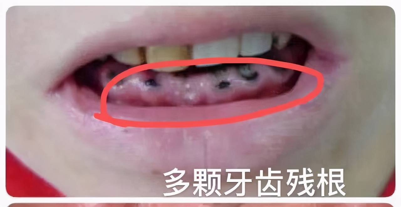 抽牙神经要抽多少次 抽牙神经多久