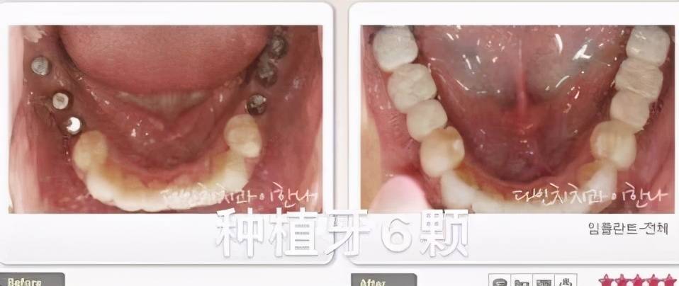 抽牙神经要抽多少次 抽牙神经多久
