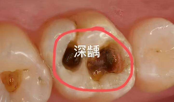 抽牙神经要抽多少次 抽牙神经多久