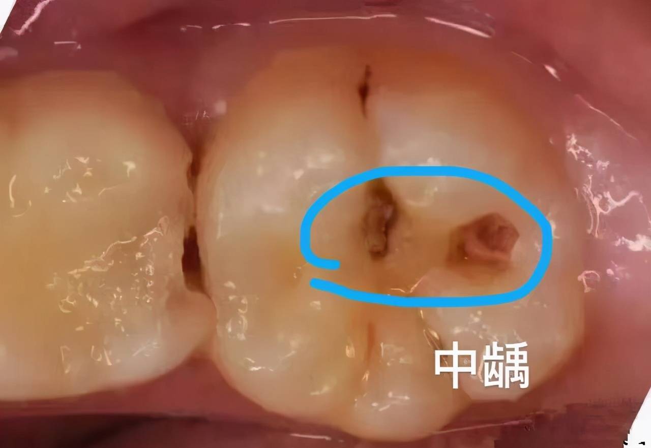 抽牙神经要抽多少次 抽牙神经多久