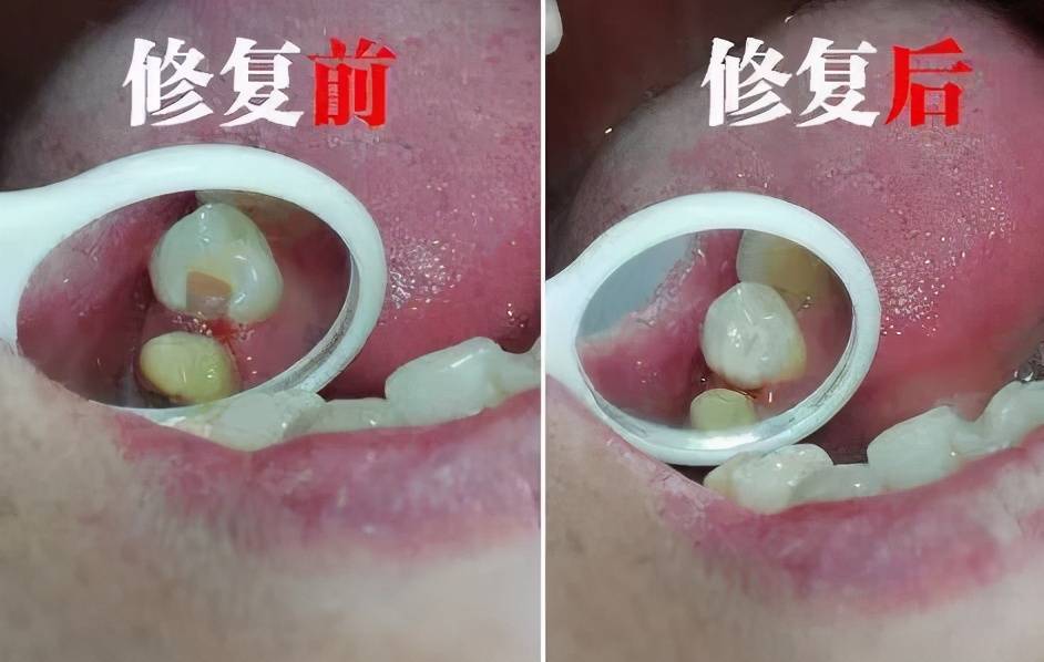 抽牙神经要抽多少次 抽牙神经多久