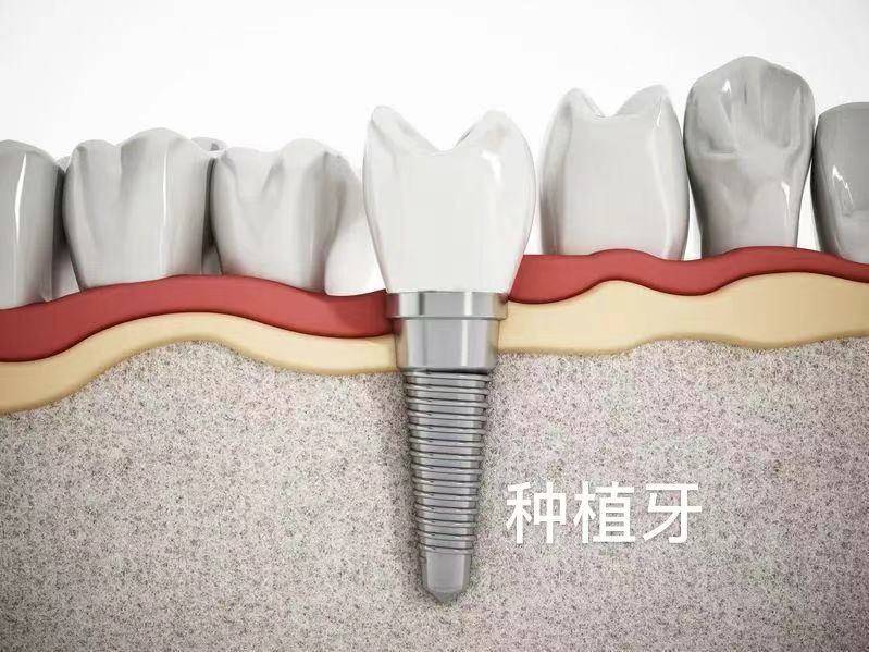 抽牙神经要抽多少次 抽牙神经多久