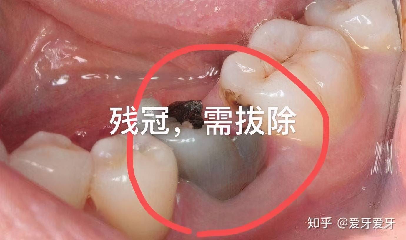 抽牙神经要抽多少次 抽牙神经多久