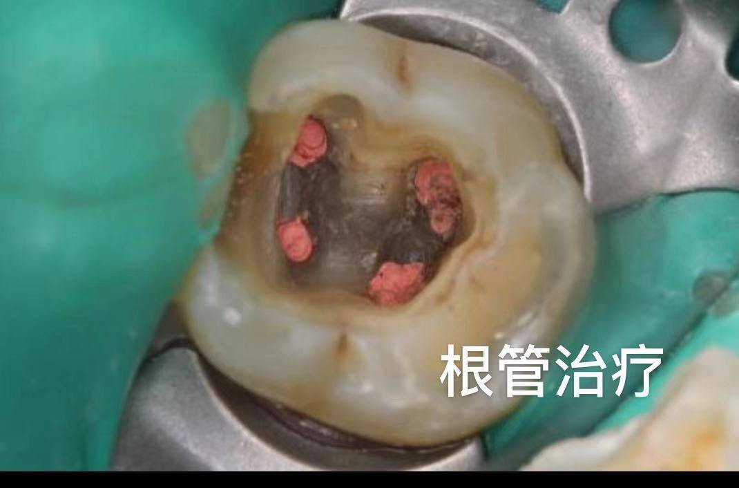 抽牙神经要抽多少次 抽牙神经多久
