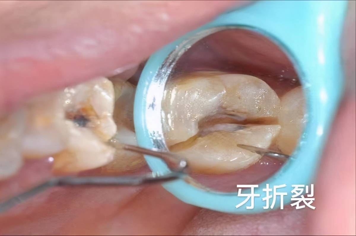 抽牙神经要抽多少次 抽牙神经多久