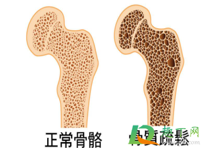 骨质疏松只补钙行不行