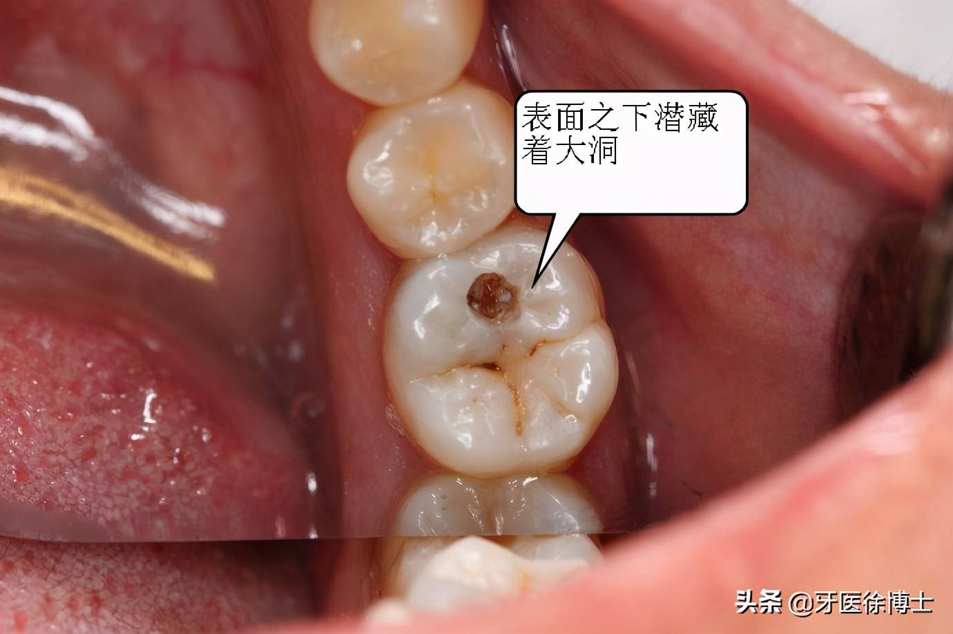 3mz350树脂补牙能用多久 树脂补牙能用多久