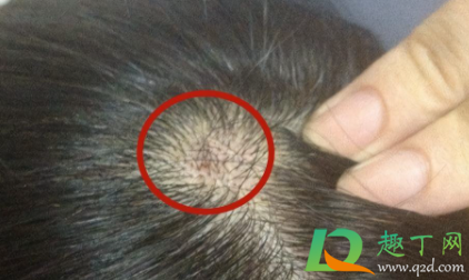 头皮长痘可以擦红霉素吗