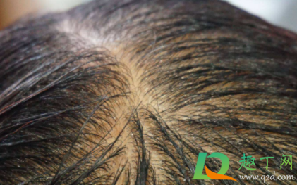 头皮长痘可以擦红霉素吗