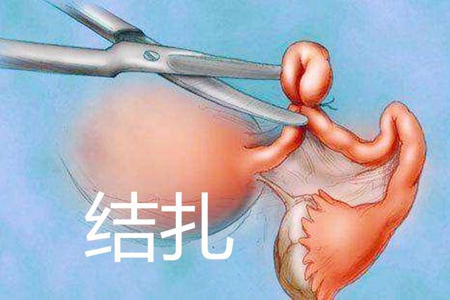 女性结扎手术多久有效果 结扎多久恢复