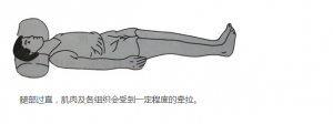 腰间盘突出正确睡姿图