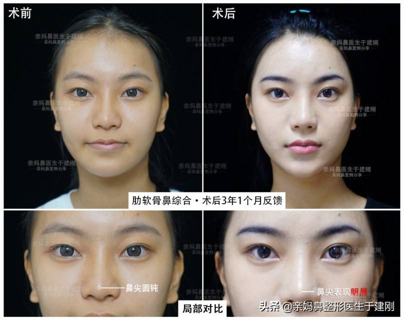 永久性的注射隆鼻 隆鼻可以维持多久