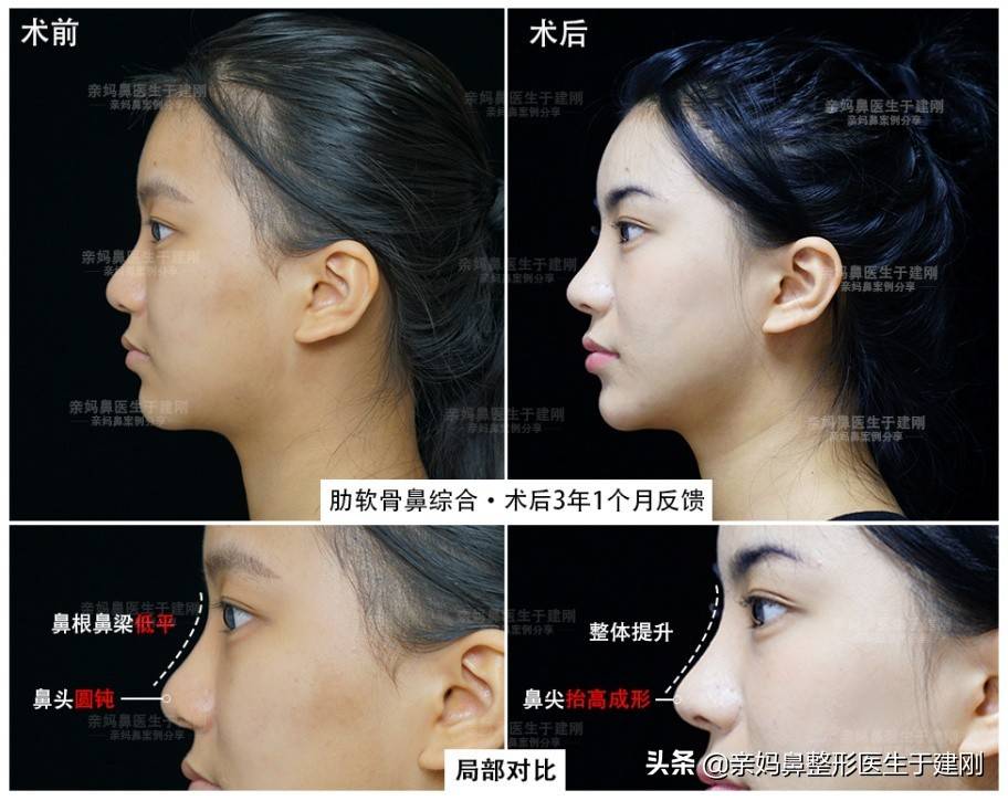 永久性的注射隆鼻 隆鼻可以维持多久
